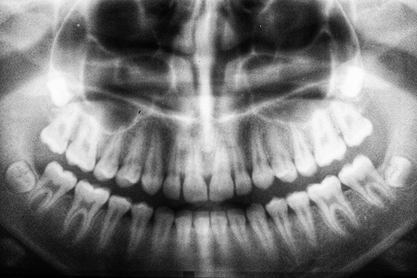 An x-ray of teeth.
